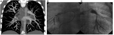 Myhre Syndrome Associated With Dunbar Syndrome and Urinary Tract Abnormalities: A Case Report